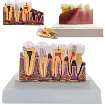 Anatomical Tooth Model with Pathologies, Removable Tooth