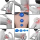 4Fizjo MED+ Silicone Cupping Therapy Set, 4 pcs, Blue