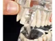 Dental Jaw Model with Implants and 14 Removable Teeth