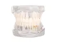 Dental Jaw Model with 14 Removable Teeth & Implants
