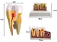 Anatomical Tooth Model with Pathologies, Removable Tooth