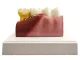 Anatomical Tooth Model with Pathologies, Removable Tooth