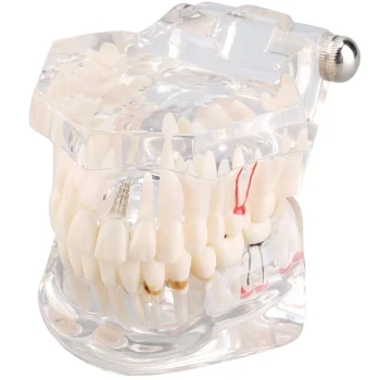 Dental Jaw Model with 14 Removable Teeth & Implants