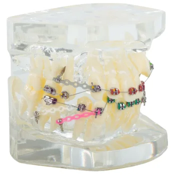 Dental Jaw Model with Orthodontic Braces, 6.5x6.5x7.5 cm