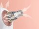 Electric Blackhead Remover Vacuum for Face Rechargeable Microdermabrasion Device, + 5 Nozzles, Different colors
