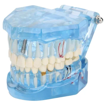 Dental Jaw Model with Implants and 14 Removable Teeth