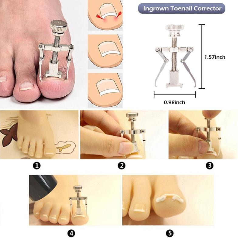 Ingrown Toenail Correction Tool Kit Pedicure Set (5)